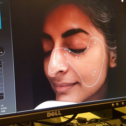 Pico Toning Laser, Dr Calvin Chan, laser treatments, rejuvenating skin treatments, antiageing skin treatments